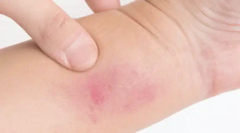 Can You Use Super Glue to Heal Cuts and Scrapes
