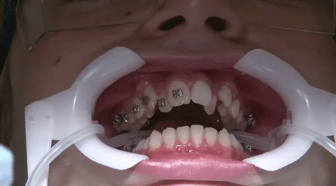 How to Take Braces Glue Off at Home